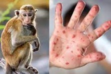 Bộ Y tế cảnh báo mầm bệnh đậu mùa khỉ trong cộng đồng